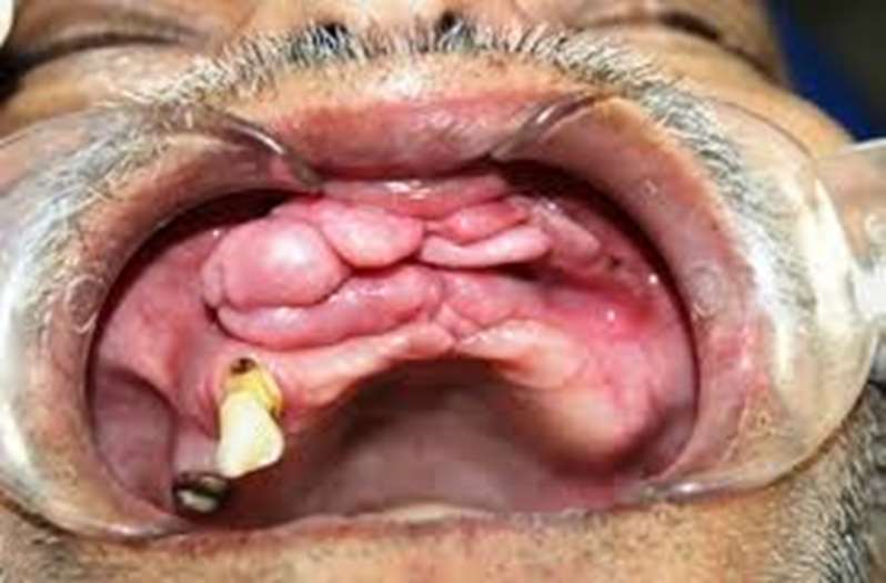 Epulis fissuratum vestibular