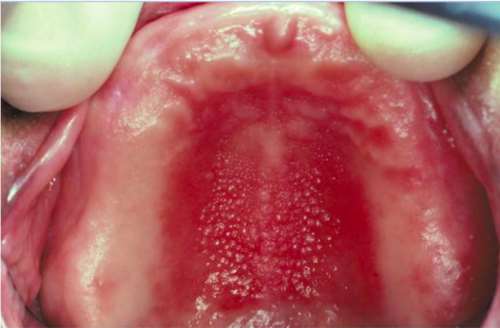 Polip fibro-epitelial palatinal