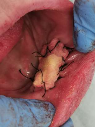 Granulom piogen gingival