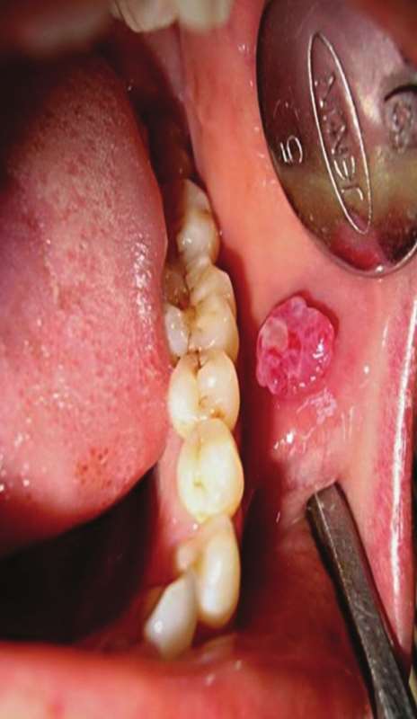 Botriomicom labial