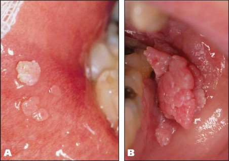 Granulom piogen gingival pediculat