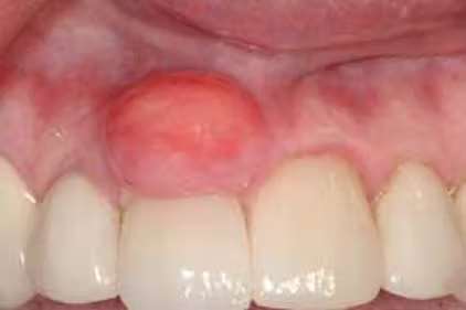 Fibrom osifiant periferic