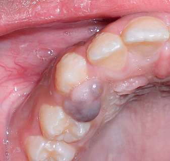 Granulom periferic cu celule gigante