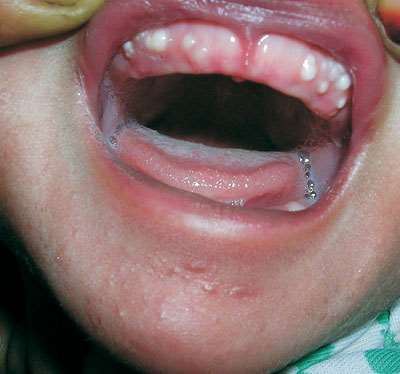 Granulom congenital — voluminos