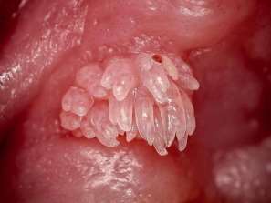 Papilom oral conopidiform