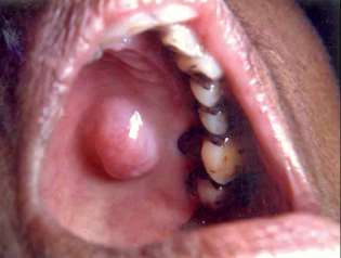 Adenom pleomorf palatinal