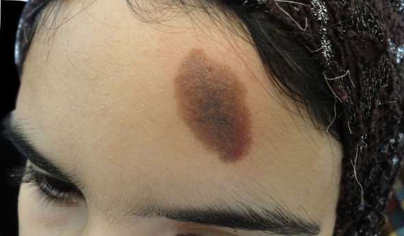 Nev melanocitic congenital