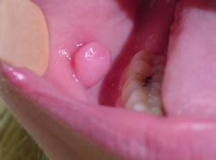 Fibrom jugal