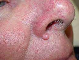 Fibrom subcutanat tegumentar