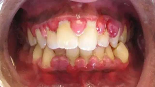 Fibromatoză gingivală generalizată