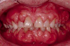 Aspect intraoperator gingivectomie