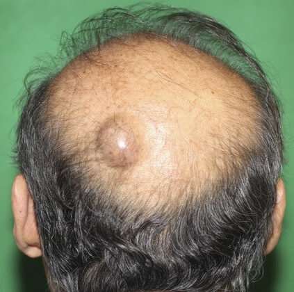 Lipom laterocervical