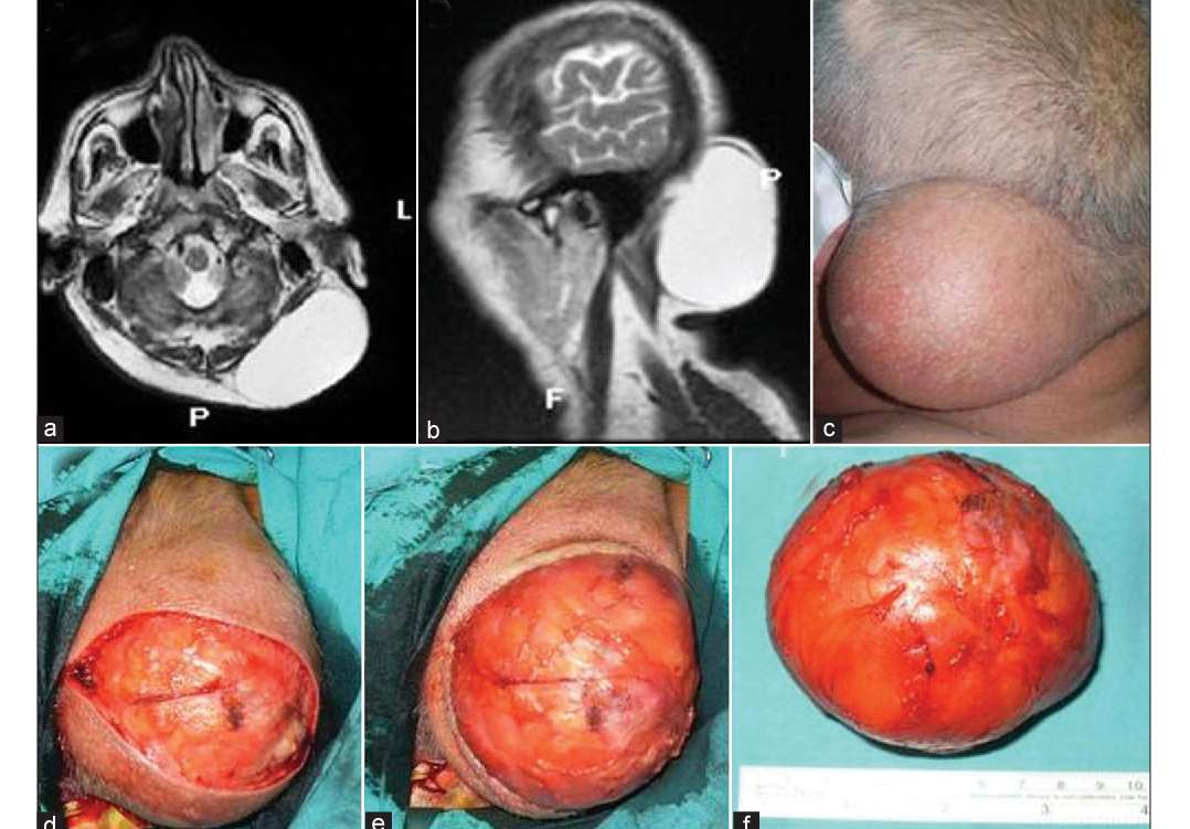 Aspect cervico-facial Madelung