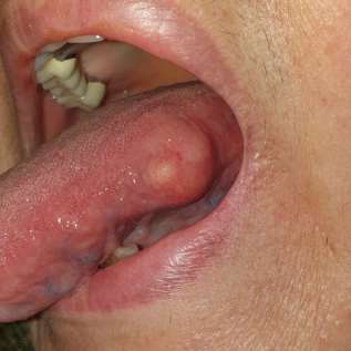 Neurofibrom solitar