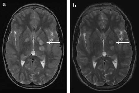 Neurofibromatoză centrală imagistică