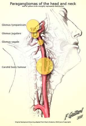 Paragangliom laterocervical