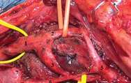 Aspect intraoperator carotidian