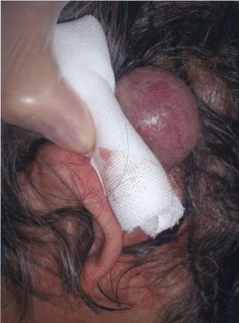Embolizare preoperatorie