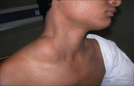 Limfangiom cervico-facial