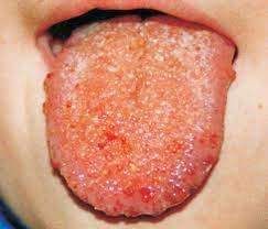 Limfangiom oral — macroglosie
