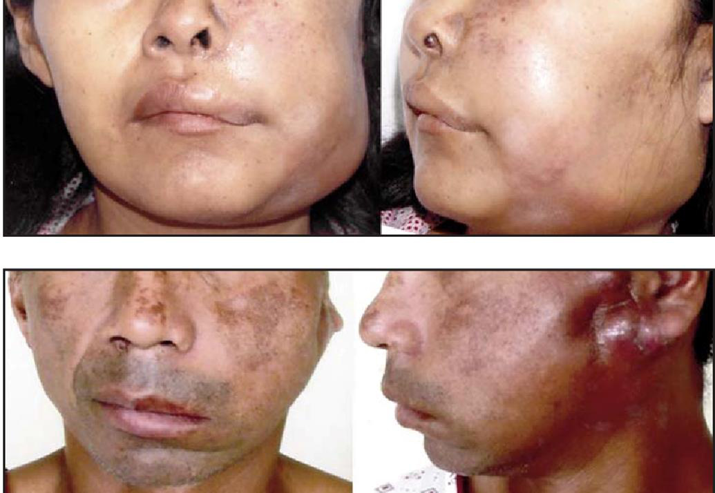 Carcinom mucoepidermoid parotidian