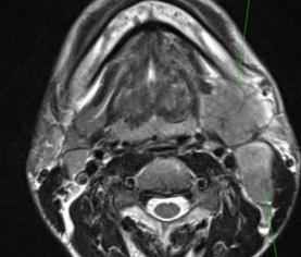 Carcinom submandibular