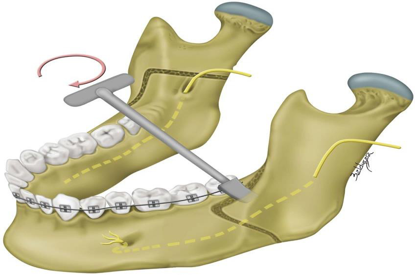 Incizia endo-orală — Obwegeser