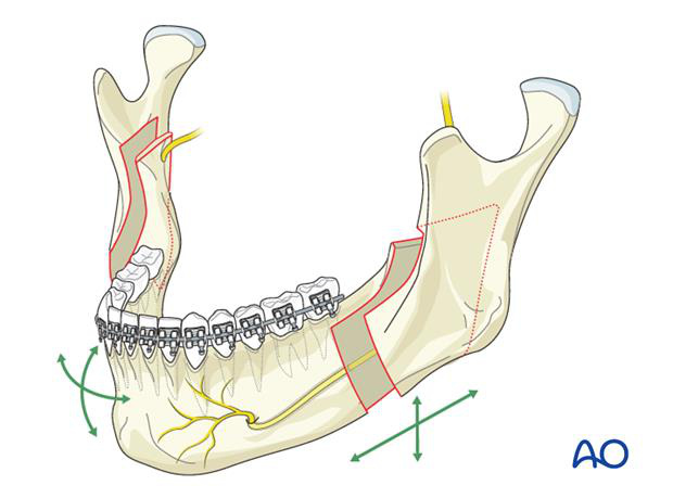 Osteotomie anterioară și trigon retromolar