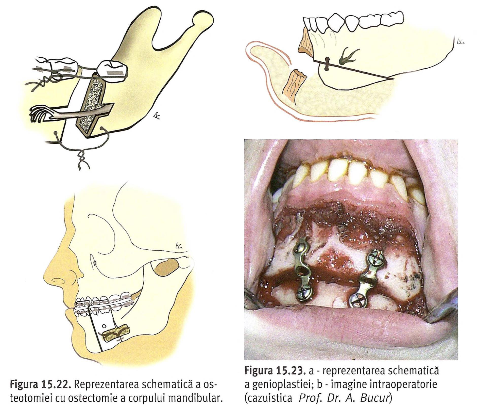 Genioplastia — incizia endo-orală