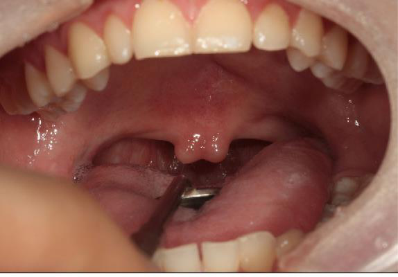 Aspect intraoperator cheiloplastia
