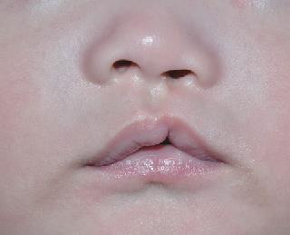 Cheiloplastia bilaterală