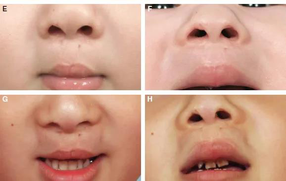 Aspect endo-oral
