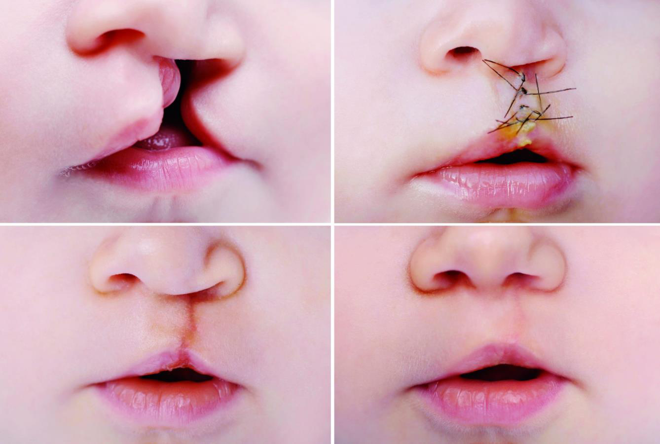 Bilaterală totală — aspect intraoral