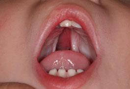 Intraoral — bilaterală