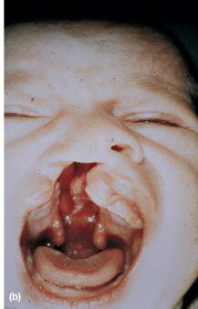 Intraoperator cheiloplastia