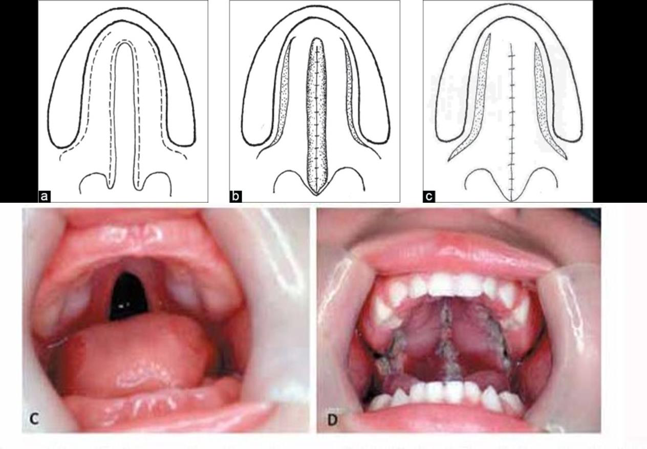 Osteoplastie secundară