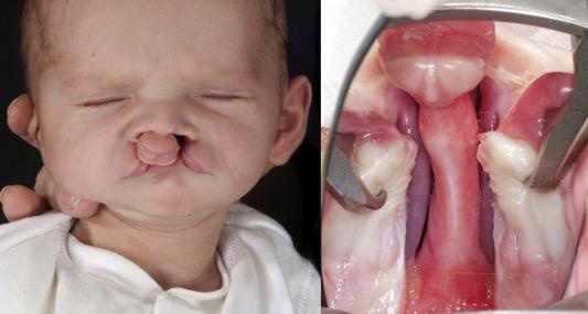 Post-cheiloplastia