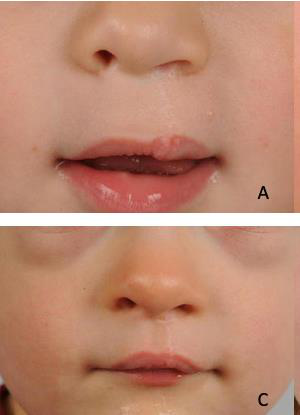 Post-osteoplastie