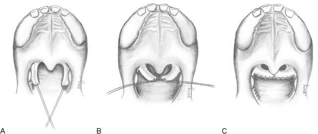 Rhinoplastie secundară