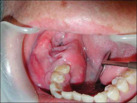 Ameloblastom multichistic — aspect clinic