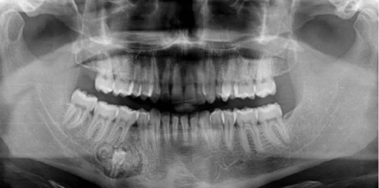 TEC — Rx cu calcificări