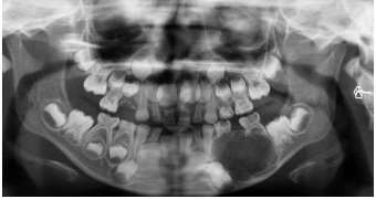 Fibromul ameloblastic