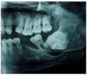 Odontom compus