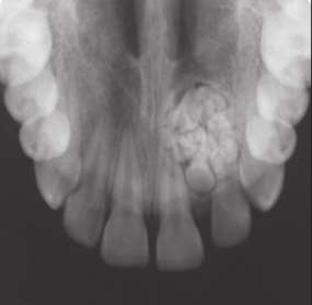 Odontom complex