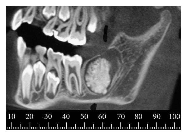 Fibro-odontom RT/RO