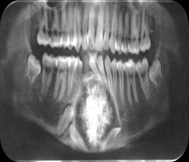 Odontoameloblastom