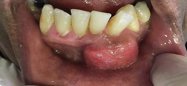 Fibrom odontogen central