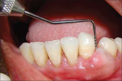 Fibrom odontogen periferic