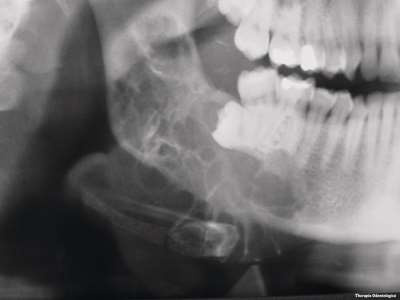 Mixom odontogen