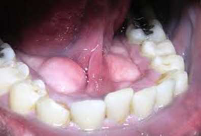 Osteom periostal